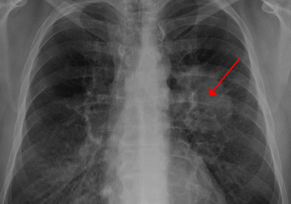 Tüdőrák: erre a 4 korai tünetre érdemes figyelnie!
